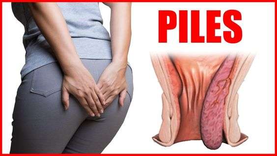 HOW To Cure Piles